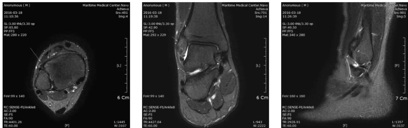 Fig.  5.  MRI  of  Patient's  right  ankle.  (axial  view,  coronal  view,  sagittal  view,  case2-2016-03-31)