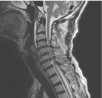 Fig.  1.  Sagittal T2 weighted image of C-spine MRI of the patient.다4).  현재  급성  척수  손상에  대한  일반적인  치료  전략으로 약물요법, 외과적 중재 및 세포 이식 치료법 등이 제시되고  있는데5), 손상  8시간 이내의  고용량 methylprednisolone 요법만이  급성척수손상에  유효성을  보이는  거의  유일한  약물요법으로  알려져  있으며6),  외과적  중재의  경우  