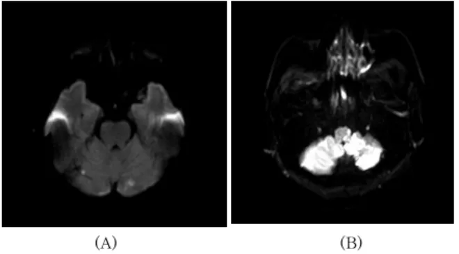 Fig.  2.  (A)  Brain  MRI  (2016.04.08.)  Multifocal  small  infarctions  in  both  cerebellum