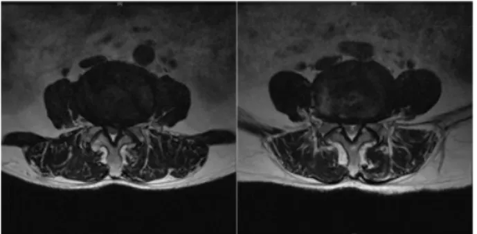 Fig.  1.  MRI  of  L-spine  T2  weighted  image  (axial  view,  2013-01-28).도가  심한  것으로  나타난다