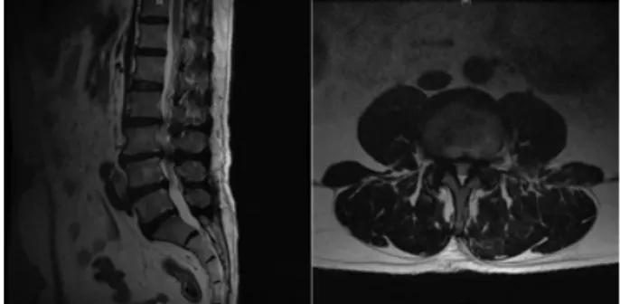 Fig.  2.  MRI  of  L-spine  T2  weighted  image  (sagittal  &amp;  axial  view,  2013-03-19).(2)  요통3)  발병일 2012년  /  2013년  3월  19일  심해짐4)  입원기간 2013년  3월  22일∼2013  3월  30일  (8일)5)  과거력별무6)  현병력  상기환자  47세  남환(174  cm/84  kg)으로  2012년  다리 저림과  간헐적  파행으로 