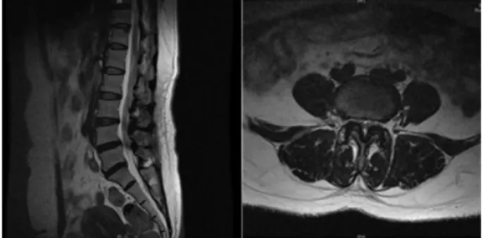 Fig.  3.  MRI  of  L-spine  T2  weighted  image  (sagittal  &amp;  axial  view,  2015-01-09).6)  현병력  상기환자  48세  여환(151.7  cm/61.9  kg)으로  식당에서 일하던  중  쪼그려  앉아서 냉장고에서  물건을  꺼내  들다가 갑자기  주저앉았다고  하였다