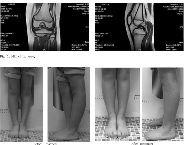 Fig.  1.  MRI  of  Lt.  knee.