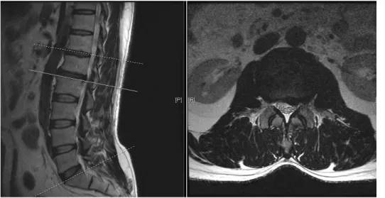 Fig.  2.  MRI  of  L-spine  T2  Fast  Recovery  Fast  Spin  Echo  image  (Sagittal &amp; Axial view, 2016-12-05).