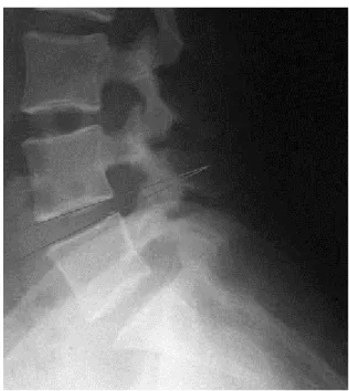 Fig.  4.  Result  of  gait  balance.