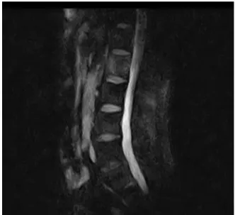 Fig.  1.  Acute  compression  fracture  of  L2.