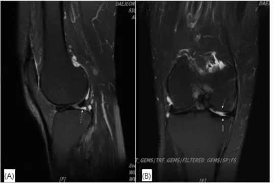 Fig.  1.  MRI  of  Right  knee  T2. 