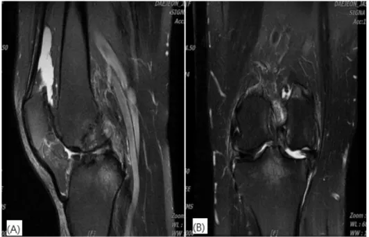Fig.  6.  MRI  of  Right  knee  T2. 