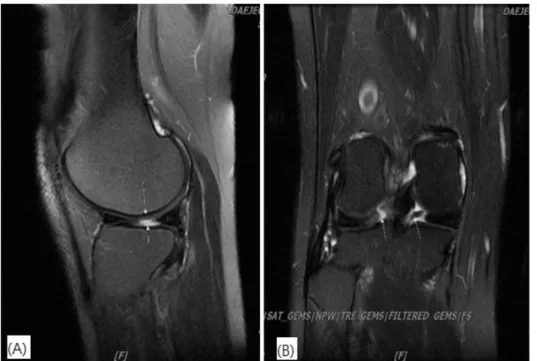 Fig.  7.  MRI  of  Right  knee  T2. 