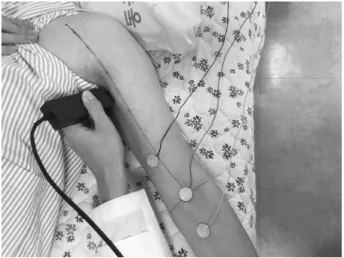 Fig.  1.  Reference  lines  of  the  location  of  the  motor  point  of  the  biceps  brachii