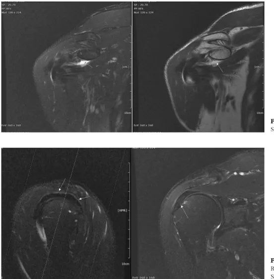 Fig.  3.  Sagittal&amp;coronal  view  of  Rt.  Shoulder  MRI  (Tendinosis. 