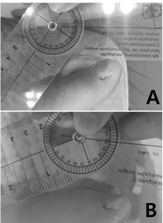 Fig.  1.  Maximum  extension  angle  of  PIP  joints  of  2∼3  toe  was  120 o   before  treatment  (A;  2017.05.16.)  and  it  was  increased  to  150 o   after  treatment  (B;  2017.05.26.)