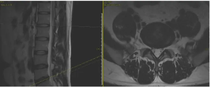 Fig.  2.  T2  weighted  sagittal  and  axial  view  of  L5/S1,  Case  1.
