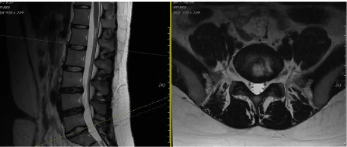 Fig.  5.  T2  weighted  sagittal  and  axial  view  of  L5/S1,  Case  4.3.  증례  31)  성명,  연령,  성별박OO(F/22)2)  주소증하요부  대맥선상  통증  및  좌측  장골릉선  및  좌측  둔부 통증,  굴곡시,  좌위시,  보행시  심화3)  발병일  및  동기2016년 12월초, 걷다가 골반 통증을 느끼고 난 후 발병함4)  과거력없음5)  현병력상기  발병  동기에  상기  