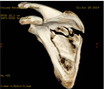Fig.  4.  Shoulder  computed  tomography  posteroanterior  view  shows  the  comminuted  fracture  in  scapular  body  and  extension  to  glenoid.