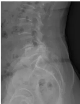 Fig.  2.  Visual  observation  of  the  pelvis  and  spine  in  case  1.
