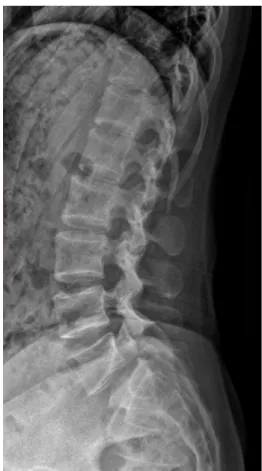 Fig.  7.  Visual  observation  of  the  pelvis  and  spine  in  case  2.