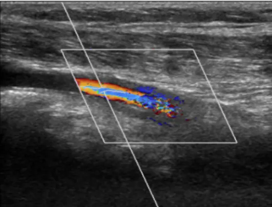 Figure 3. The result of Lower extremity vascular doppler US