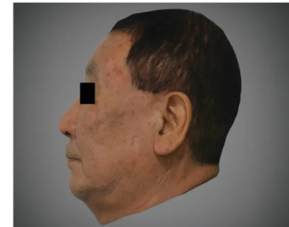 Figure 1. Anterior and lateral view of the face captured by Nikon D5100 Table 1. The Records of Patients' Initial State