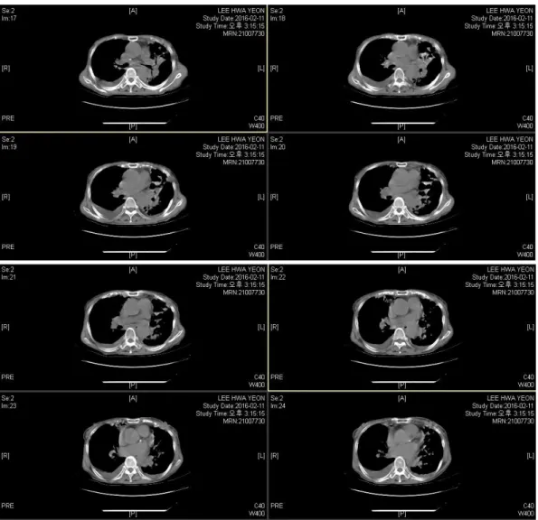 Figure 2. The chest computed tomography(CT) on Febraury 11th 2016.