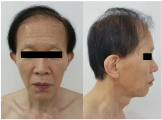 Figure 2. Anterior view and lateral view of face taken by  digital camera (MAR-5-2015).