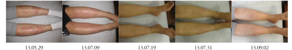 Figure 1. Pictures of psoriasis on lower limbs. 
