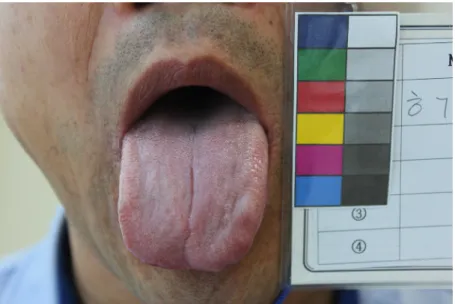 Figure 2. Picture of tongue for the assessment. 0, 혀에 수분이 전혀 없는 상태를 100으로 하였으며,  치흔 정도, 점자 정도, 와사 정도는 전혀 없는 상태를  0,  가장 심한 상태를 100으로 하여 평가하였다