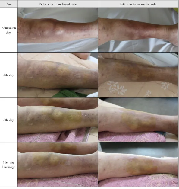 Figure 1. Progress of hematoma lesion