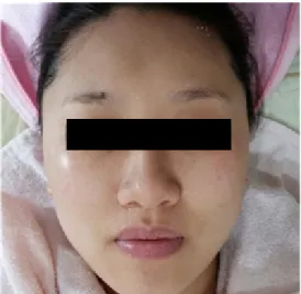 Figure 1. Before applying IPL(2014.02.27.)  Figure 2. A week after applying IPL(2014.03.08.)   2