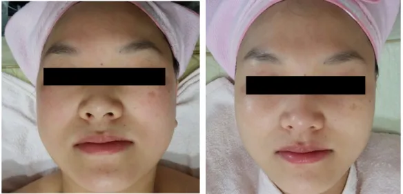 Figure 5. Before applying IPL(2014.03.07.)  Figure 6. A week after applying IPL(2014.03.14.)