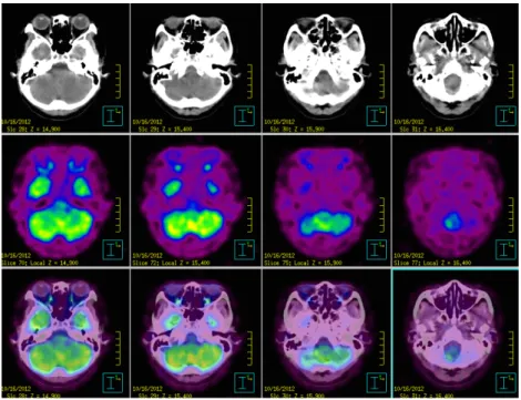 Figure 3. Whole body positron emission tomography-computed tomography(PET-CT)