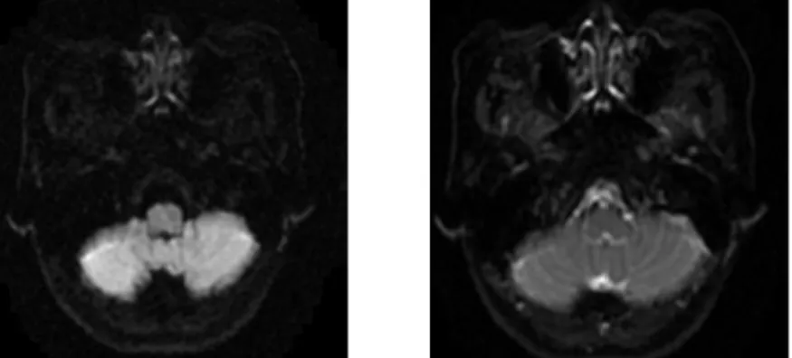 Figure 4. Brain magnetic resonance imaging(MRI) 물인 荊芥 防風 羌活 獨活 車前子를 가하였다 16 .  荊防地黃湯 복용 후 眩暈과 보행 장애, 운동 실 조,  어둔감 등 주증으로 호소하는 모든 증상들이 서서 히 좋아지기 시작했다 (Figure 2)