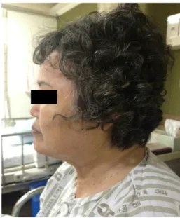 Figure 1. Face of patient(front view)  Figure 2. Face of patient(lateral view) 2) 만성위염 : 1990년경부터 주기적으로 재발하여 증상발생시 양약복용중임.3) 우울증 : 2011년경 세브란스병원에서 약물치료 시행함.7