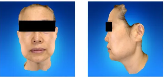 Figure 1. Anterior and lateral view of face scanned by 3D facial scanner 7. 과거력1) 자궁근종 - 2011년 진단2) 수술력 - 2012년 12월 14일 낙상으로 우측 다리 골절되어 수술8