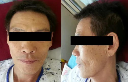 Figure 1. Anterior and lateral view of patient 2) 성질재간 예민하며 날카로운 성격을 보이며 급하고 직설적 인 태도를 보인다