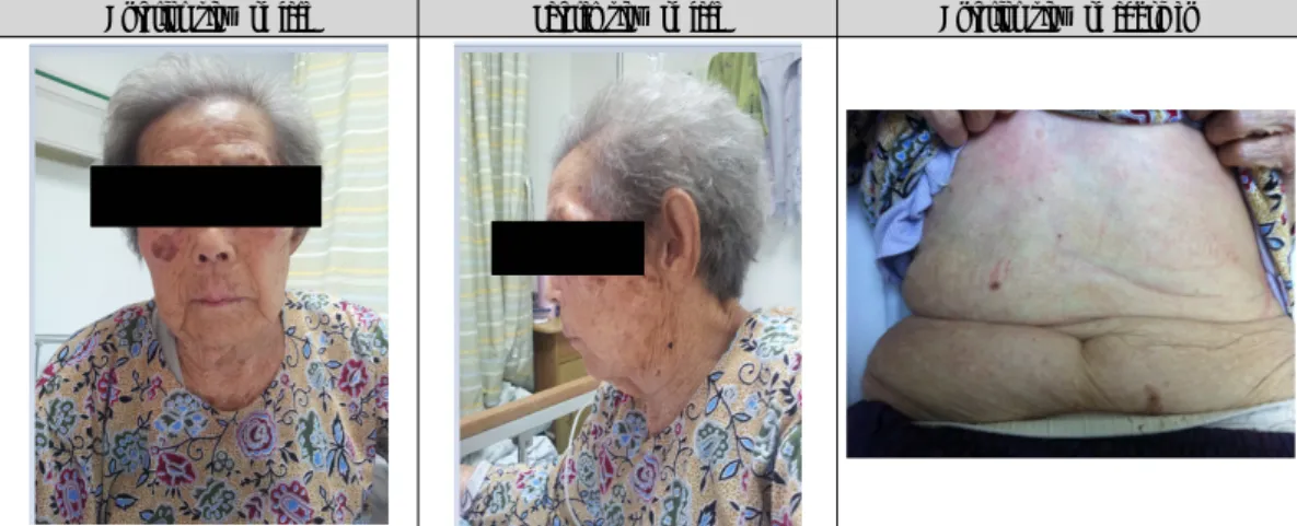 Figure  1.  Face  and  Abdomen  of  Patient