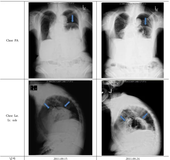 Figure 2. Chest X-ray 