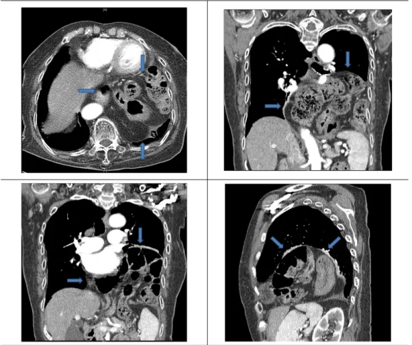 Figure  3.  Chest  CT(2011.09.21)