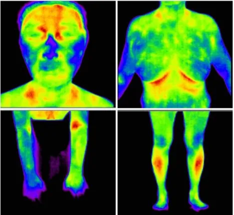 Figure 5. DITI on whole body(after) – 2012.05.12 환자의 종합적인 체질 소견과 소증 상태를 평가하 여 太陰人 肝受熱裏熱病 燥熱證의 범주로 판단 하고, 熱多寒少湯의 적응증으로 ○○대학교 약제실 에 조제한 열다한소탕가감방 과립제를 투여하였다