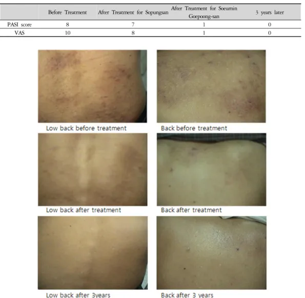 Table 3. Severity Score of Psoriasis 