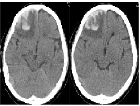 Figure  1.  The  front  &amp;  lateral  side  of  face Figure  2.  Brain  CT  (2011.04.19) 3) 운동검사 (Motor Examination)11