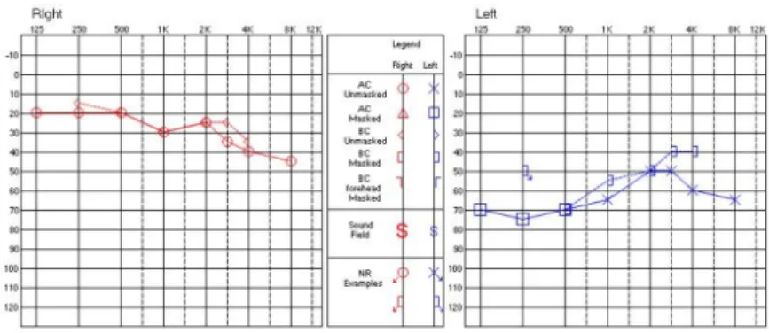 Figure  1.  Pure  tone  adiometry(2/17)