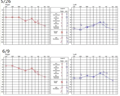 Figure  3.  Pure  tone  audiometry 3) 불면 5월 24일~5월 29일까지는 5-7시간 정도 수면 취했 으나 수면 시 지속되는 이명으로 인해 잠들기 힘들고  자주(4-5차례)  깨는 양상이었다