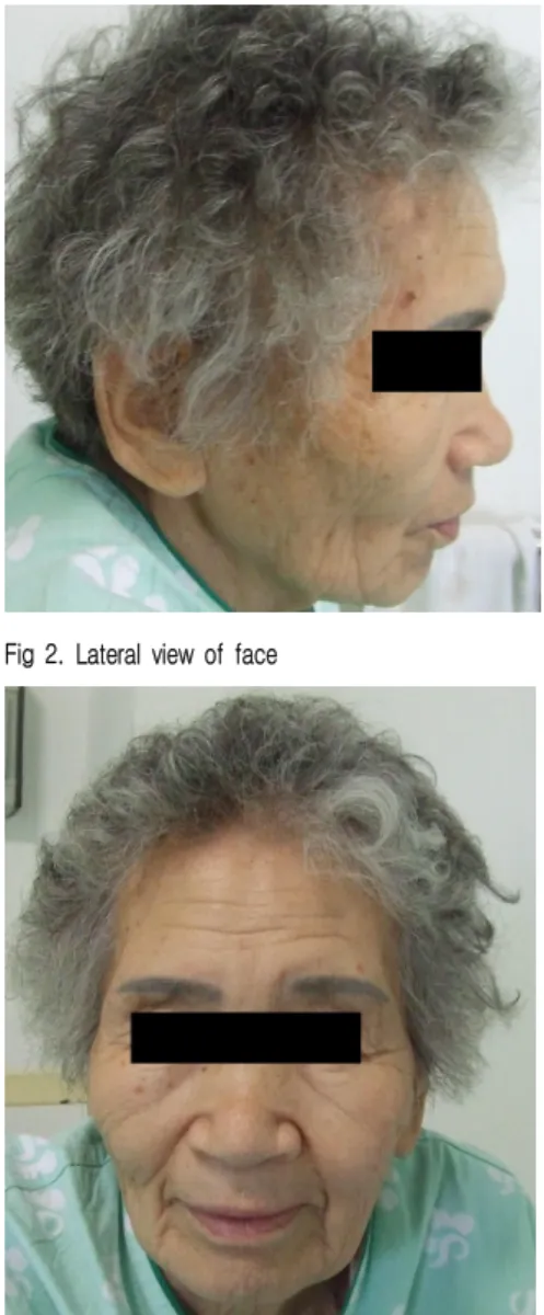 Fig 2. Lateral view of face