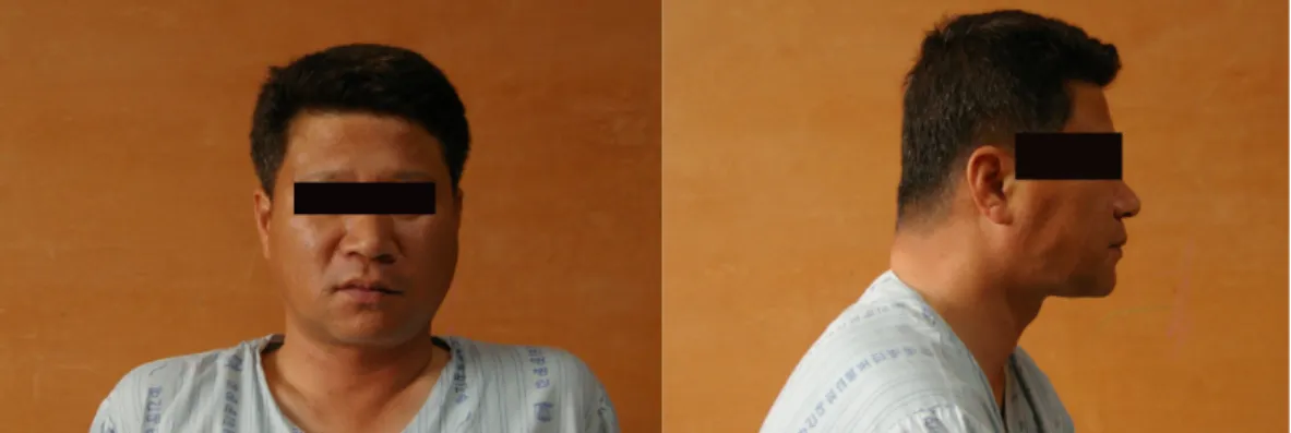 Fig. 1. Anterior view of patient's face Fig. 2. Laternal view of patient's face