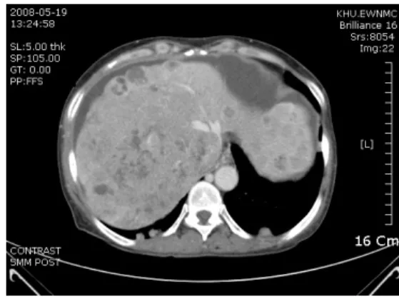 Fig.  1.  Abdominal  CT(2008.5.19)이며 복수로 인해 기립시 자세를 정확히 판단하기 힘드나 흉곽이 발달한 양상을 보인다.② 용모사기 :  관골이 발달되어 있고 이마가 돌출되어 있으며 하악이 갸름한 역삼각형의 얼굴이다