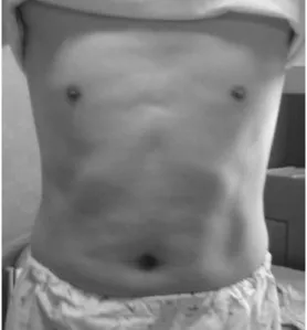 Fig.  1.  Anterior  View  of  Patient's  Face  and  AbdomenⅠ. 緖  論 한 눈이 어떤 물체를 직시할 때 다른 한 눈이 그것과 다른 방향으로 향하는 것을 斜視라 하며,  안근마비의 유무에 따라 마비성 사시와 비마비성 사시로 분류된다1.마비성 사시는 眼筋의 한 개,  또는 몇 개가 마비되어 시선의 방향에 따라 사시의 정도가 달라지며 마비된 筋에 따라 안구운동 장애가 나타나고 複視,  異常頭位,  定位誤認,  현