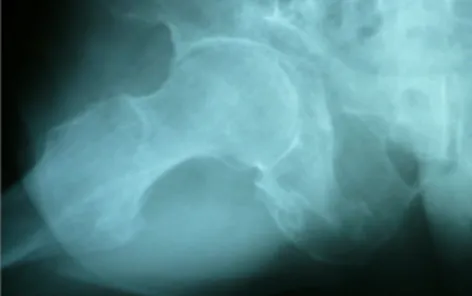Table 1. Medication Treatments Fig. 4. Rt Hip X-ray (Frog leg view)