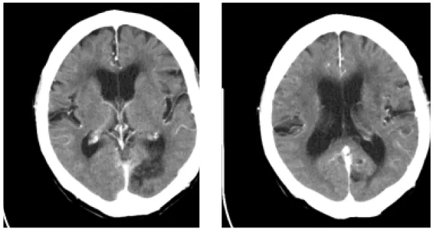 Fig.  5.  Brain  CT(Enhancement) Fig.  6.  Brain  CT(Enhancement)