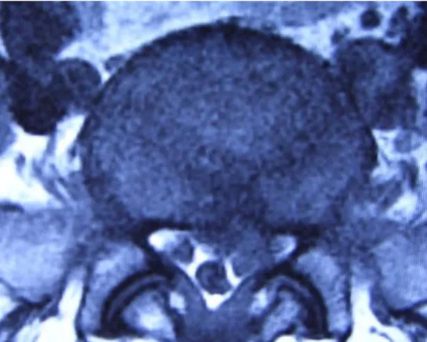 Fig 1. The L-spine MRI of the Patient(Axial Image) Fig 2. The L-spine MRI of the Patient(Horizontal Image) 10.10.10